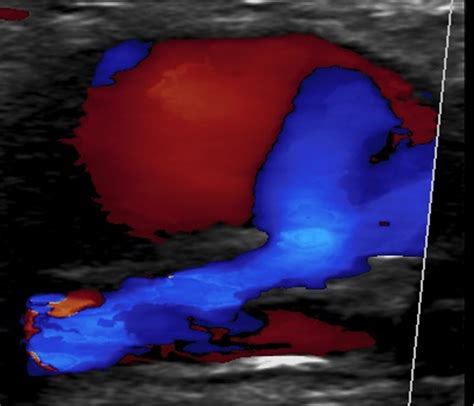 Evaluation Of Pelvic Varicose Veins Using Color Doppler Ultrasound