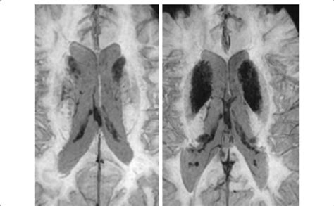 T2 Gradient Recalled Echo Gre Sequence Mri Axial Sections Showing