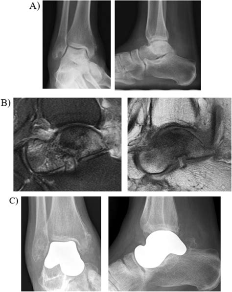 Total Talus Arthroplasty For Talar Avascular Necrosis A AP And Lateral