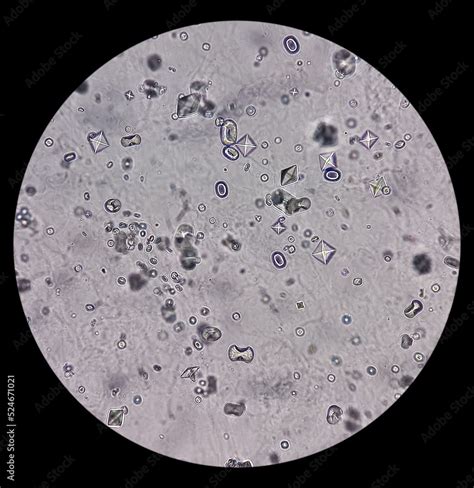 Microscopic Image Showing Calcium Oxalate Monohydrate And Dihydrate