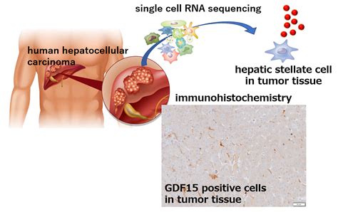 Liver Cancer Cells Manipulate Stromal Cells Involved In Fibrosis To Promote Tumor Growth Resou