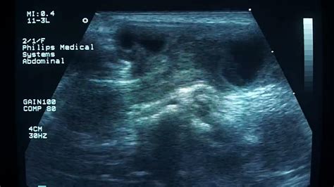 Small Bowel Obstruction Due To An Incarcerated Inguinal Hernia Youtube