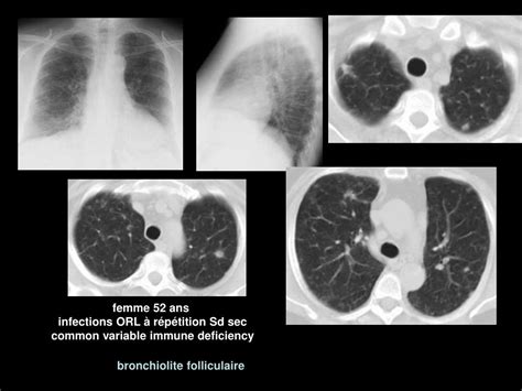 Ppt Le Syst Me Lymphatique Du Parenchyme Pulmonaire Et Sa Pathologie