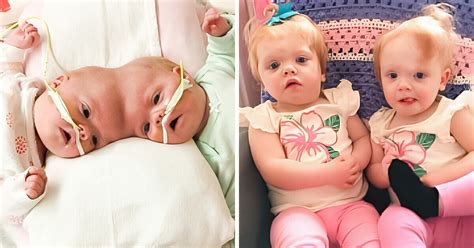 Formerly Conjoined Twins Beat 2 Survival Odds And Reach Their First Life Goal Bright Side