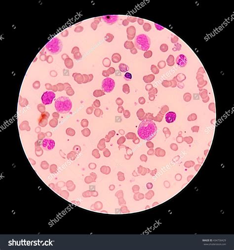 White Blood Cells Peripheral Blood Smear Stock Photo 434758429 ...