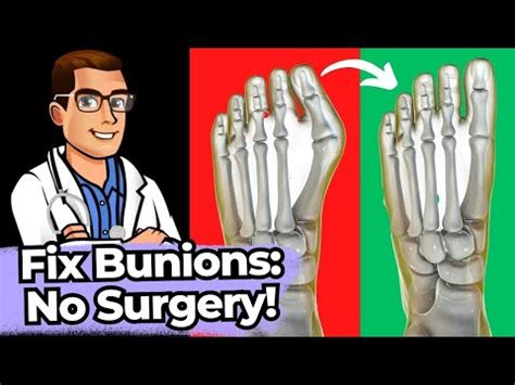 What Is A Bunion? [Causes, Symptoms & Best Treatment]