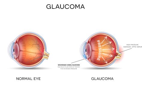 La Presi N Intraocular Por Glaucoma Se Reduce Gracias A Nueva