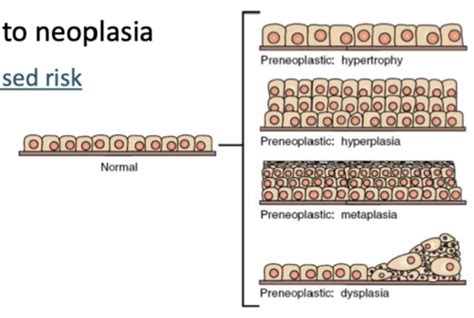 Path Neoplasia Development And Causes Flashcards Quizlet