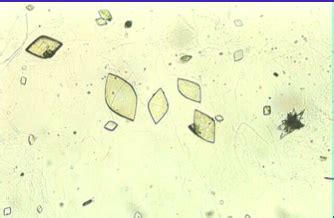 Microscopic Urine Crystals/Casts (Pictures) Flashcards | Quizlet