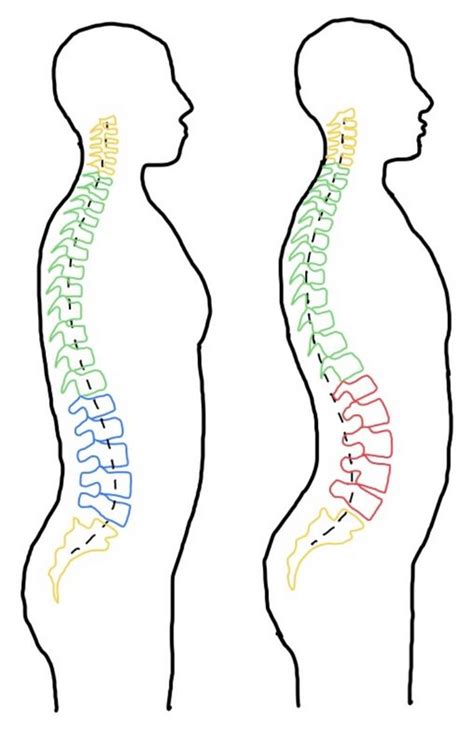 Lumbar Conditions in Ballet Dancers - Physiopedia