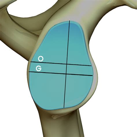 Anterior Posterior Glenoid Length Reference Lines O Corresponds To Download Scientific