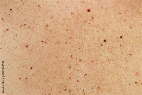 Moles And Birthmark On Human Skin Texture Photo Horizontal Full Frame