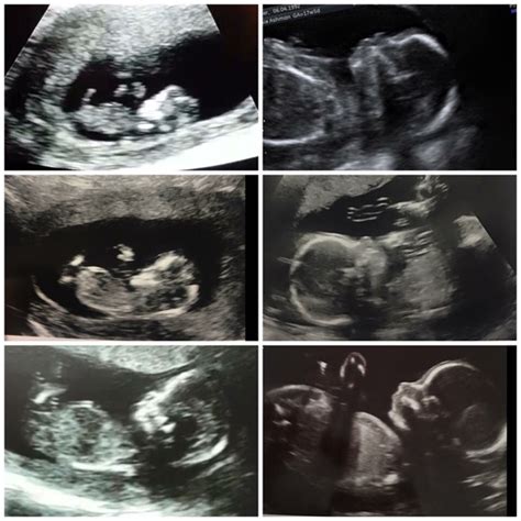 10 Week Private Scan Mumsnet