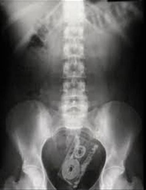 X Rays That Prove People Will Shove Pretty Much Anything Up Their Butts