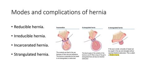 Inguinal And Femoral Hernia Ppt