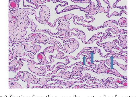 Figure 2 From Retiform Sertoli Leydig Cell Tumor In A 38 Year Old Woman