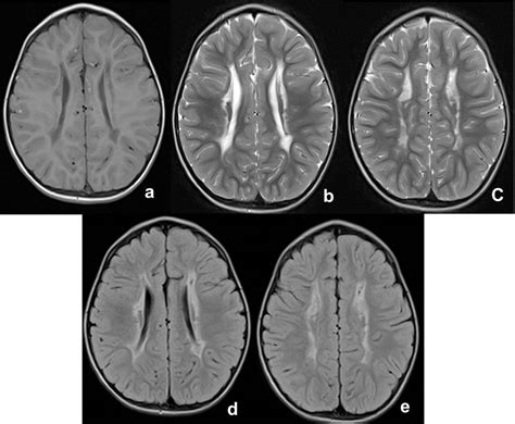 Bilateral Periventricular Leukomalacia Pvl Radiology Cases