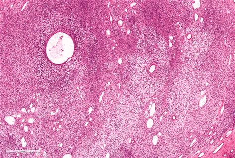 Pathology Outlines Metanephric Stromal Tumor