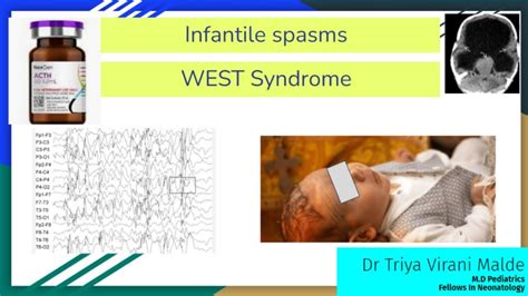 Infantile Spasms West Syndrome With Eeg Neet Pg Fmg Ini Cet