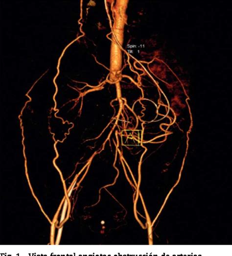 Figure 1 From Edema Pulmonar Tipo Flash Secundario A Trombosis De La Arteria Renal Síndrome De