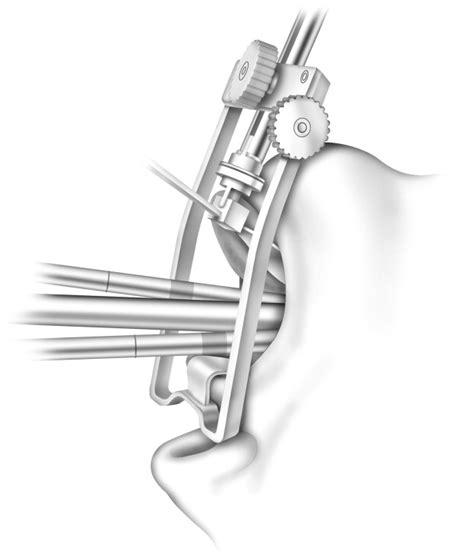 Transoral Robotic Surgery Operative Techniques In Otolaryngology Head And Neck Surgery