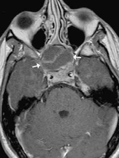 Transverse T1 Weighted Mr Image After Contrast Administration Note