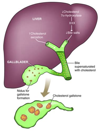 Disorders Of The Biliary Tract And Pancreas Flashcards Quizlet