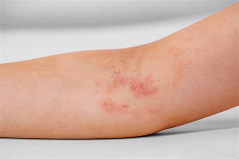 Atopic Dermatitis Symptoms Causes Diagnosis And Treatment Natural