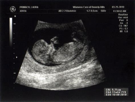 Our Little Munchkin 3 Month Ultrasound