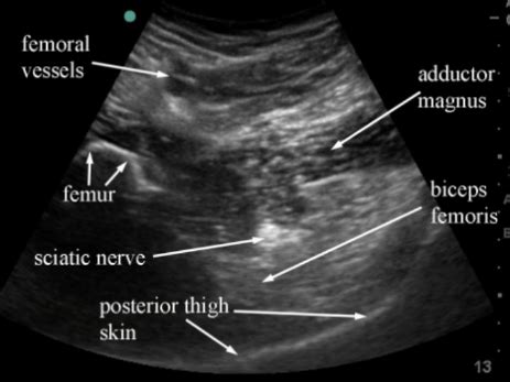 Sciatic Anterior Block | Dr Peter Hebbard