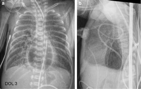 Portable Anteroposterior A And Cross Table Lateral Supine B Chest