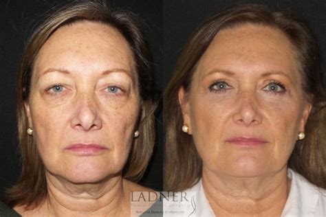 Upper Blepharoplasty Before After