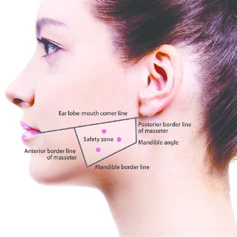 Pdf Botulinum Toxin Type A For Treatment Of Masseter Hypertrophy Volumetric Analysis Of