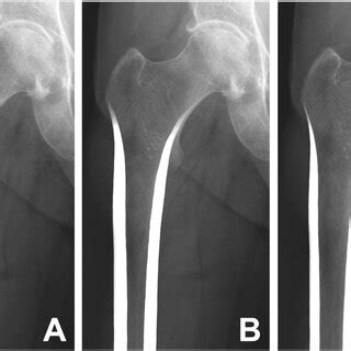 Schematic Overview Of The Variations In Proximal Femoral Canal