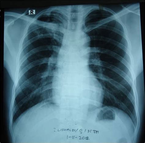 Sudiyatmomd Blog And Journal Aspergiloma Pada Pasien Pasca Tb Paru