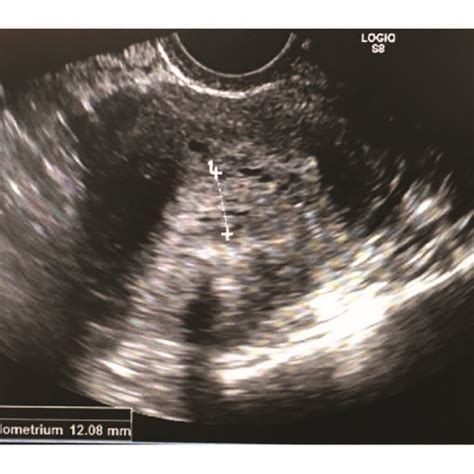 Ultrasound imaging of uterus demonstrating endometrial lining measuring ...