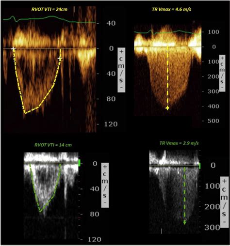 Right Ventricular Outflow Tract Velocity Time Integral And Tricuspid Download Scientific