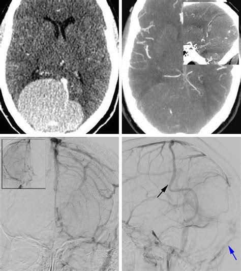 Peritorcular Meningioma The Neurosurgical Atlas