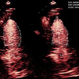 Echocardiography showing biventricular systolic dysfunction with ...