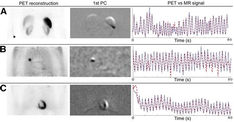 Practical Pet Respiratory Motion Correction In Clinical Petmr