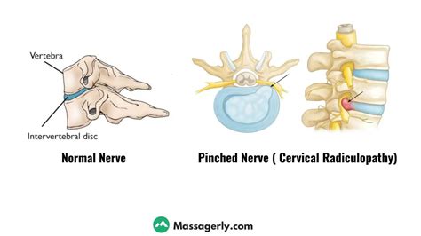 4 Effective Ways: How Can Massage Help a Pinched Nerve ? - Massagerly