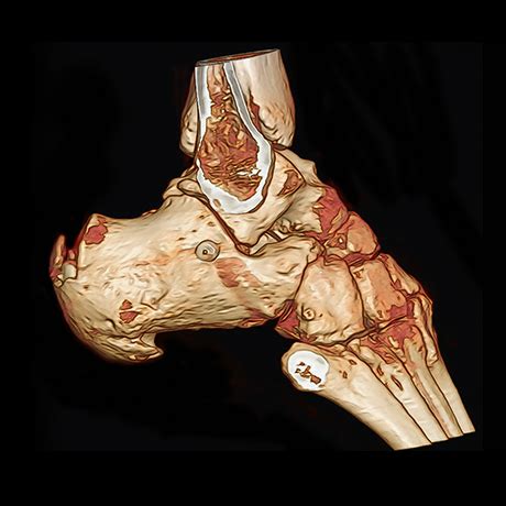 Calcaneal Fracture Comminuted Both Sides Minimal Invasive Treatment