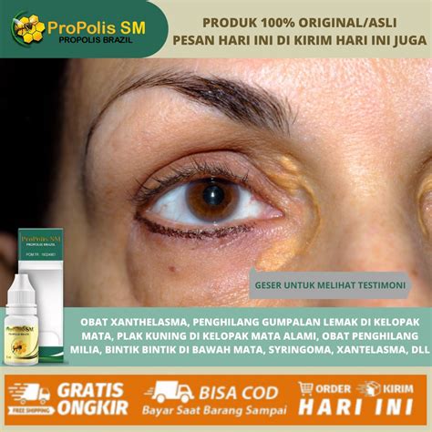 Jual Obat Penghilang Xanthelasma Alami 100 ASLI Obat Penghilang