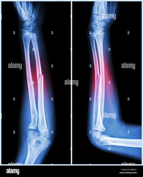 Arm Fracture X Ray Oblique