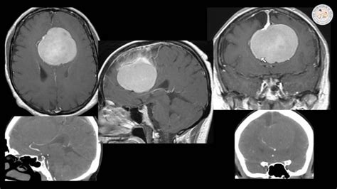 Large Parafalcine Meningioma Operative Video Cases The