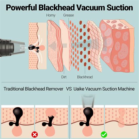 Expert tips for safe blackhead removal videos 2023 style work 29
