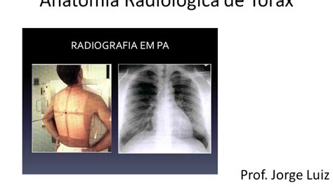 Anatomia Radiológica De Tórax Youtube