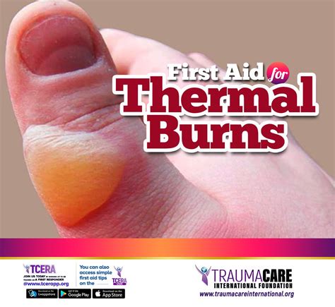 First Aid For Thermal Burns Trauma Care International Foundation