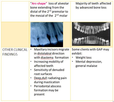 Aggressive Periodontitis Focus Dentistry