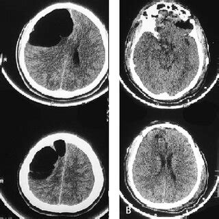 Ct Brain Of Case Showing Tension Pneumocephalus And Pneumoventricles